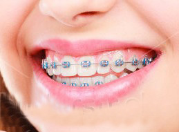 Stock-photo-dentist-and-orthodontist-concept-woman-smile-showing-her-white-teeth-with-blue-braces-thumb-up-679577266